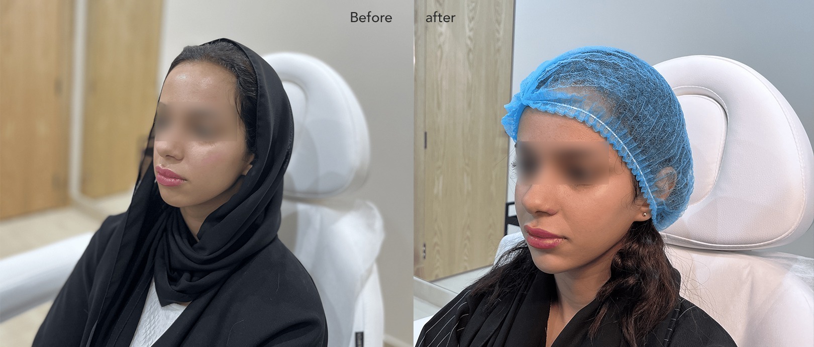 Non Surgical lifting before and after treatment for a woman