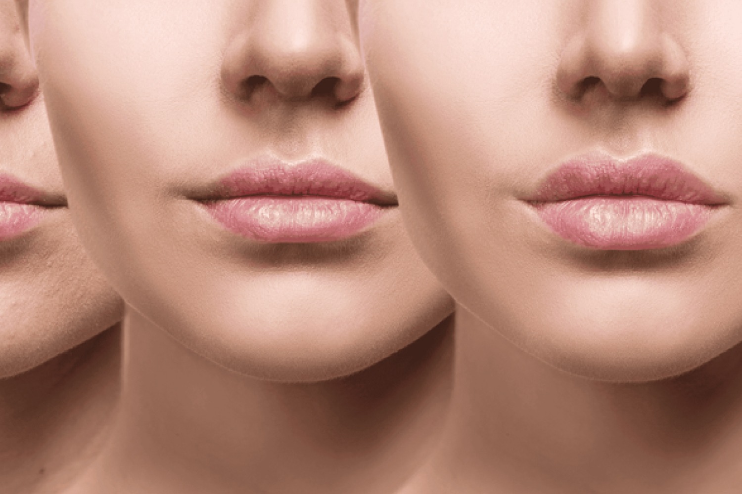 Lip and cheek enhancement with natural fillers at Reveal Clinics Riyadh