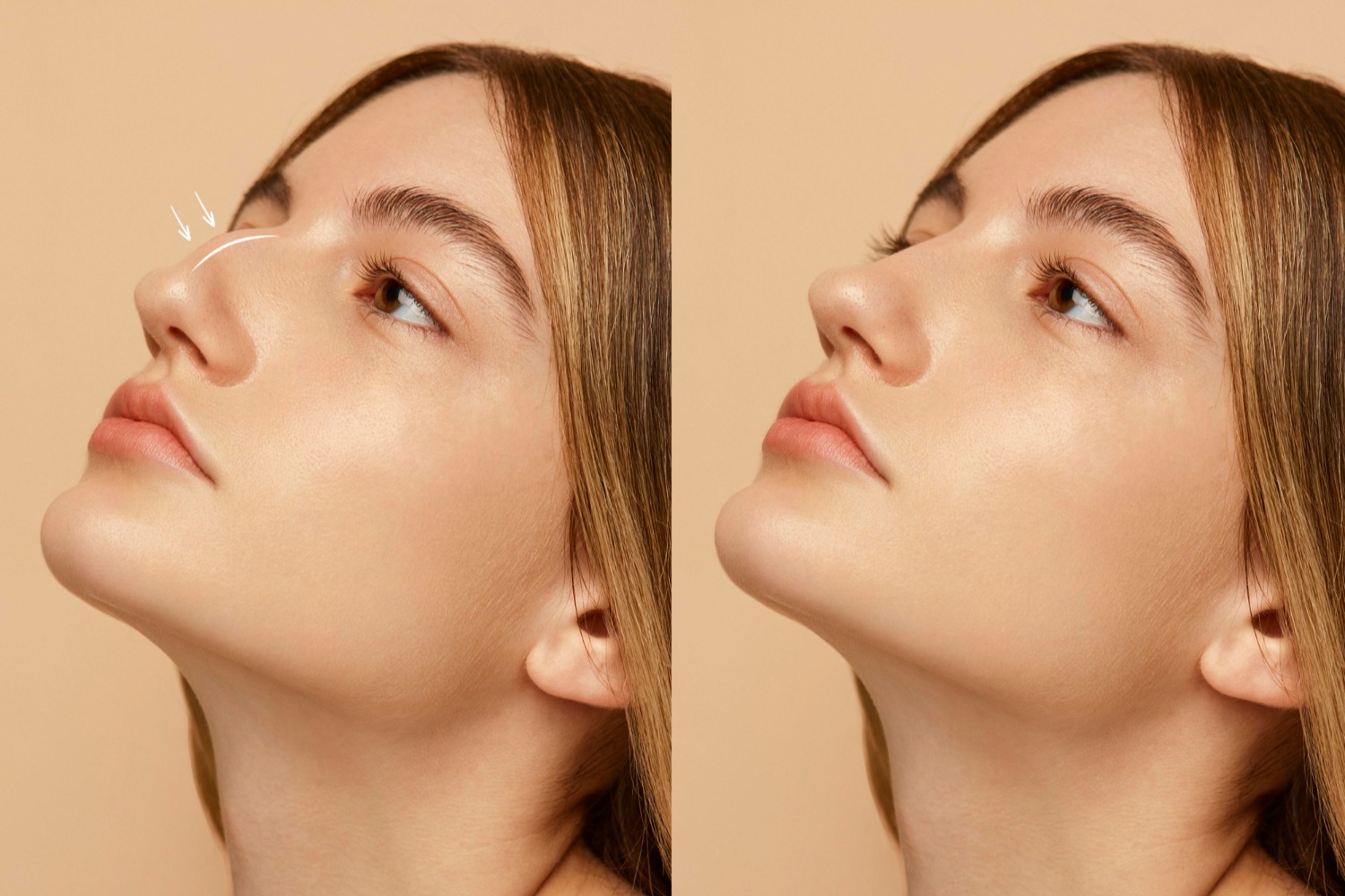 Non-surgical liquid rhinoplasty using dermal fillers at Reveal Clinics Riyadh