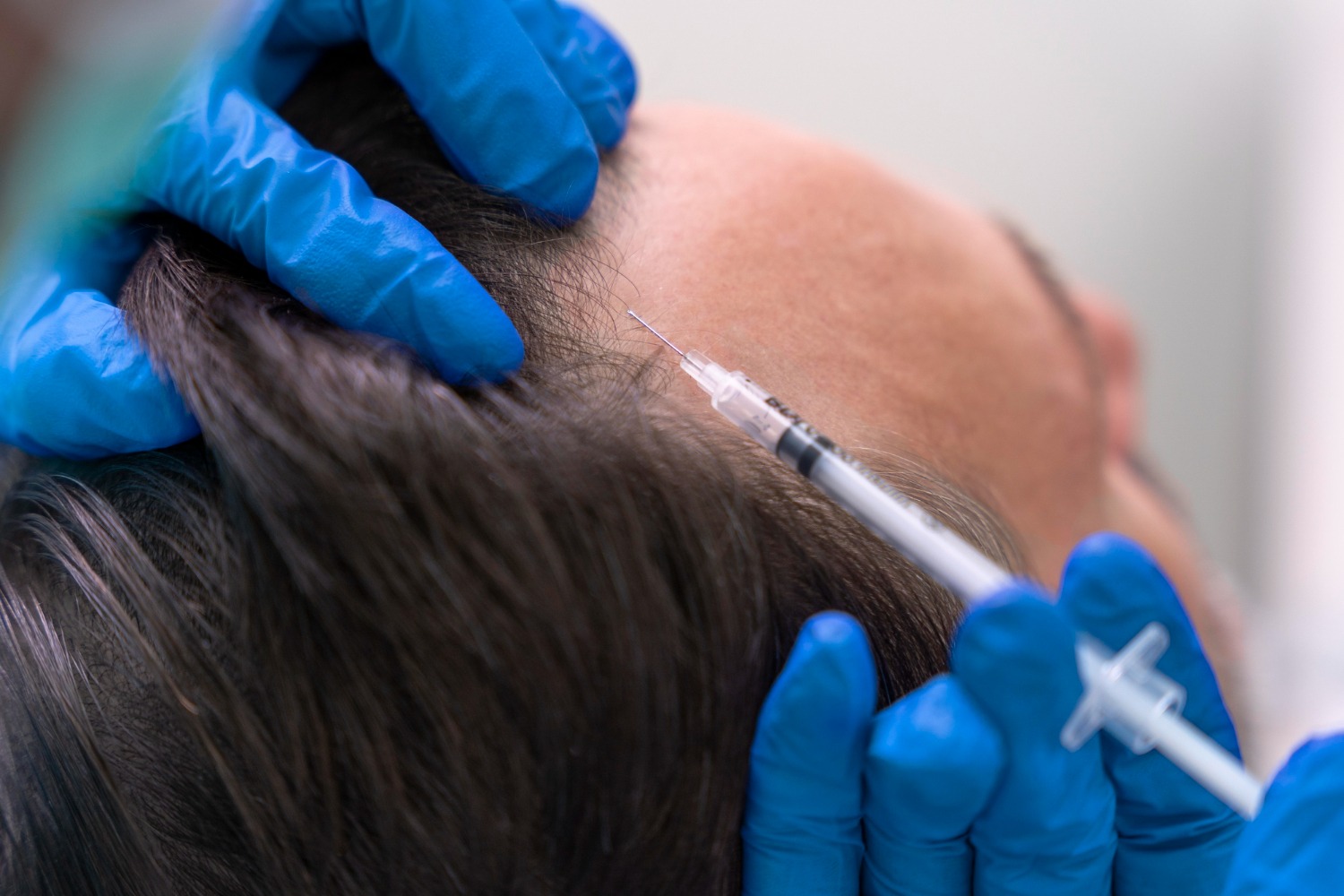 Injectable Minoxidil therapy for hair regrowth at Reveal Clinics Riyadh