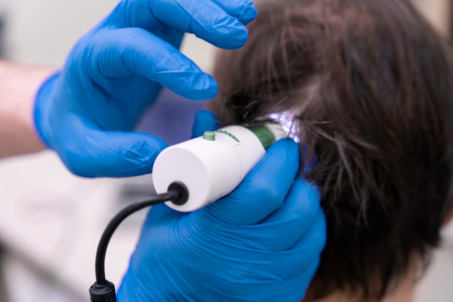 Woman getting ResurFX laser hair loss treatment at Reveal Clinics in Riyadh