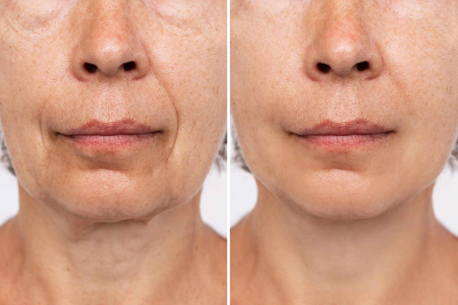 before and after ultherapy results showing improved skin lifting and firmness