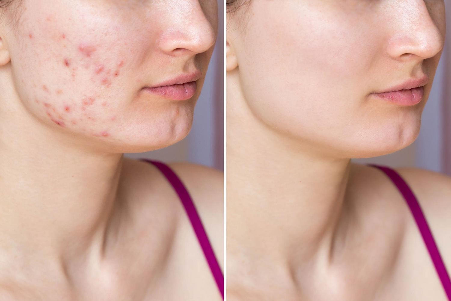Before and after Fractional CO2 laser results showing acne scar and texture improvement