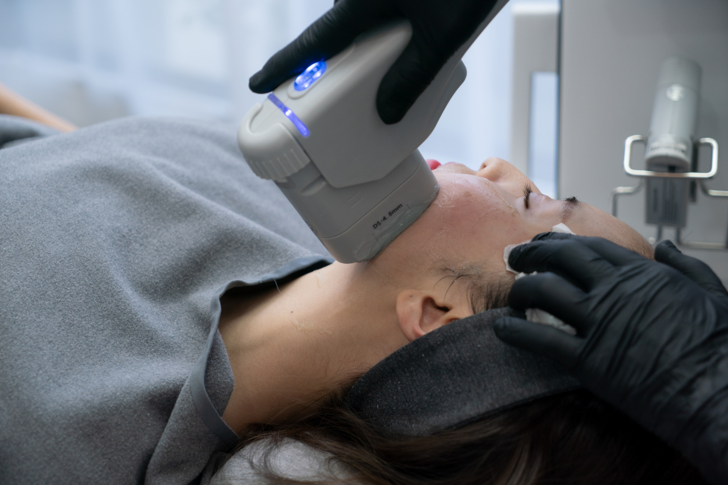 benefits of m22 ipl treatment for pigmentation and redness at reveal clinics riyadh