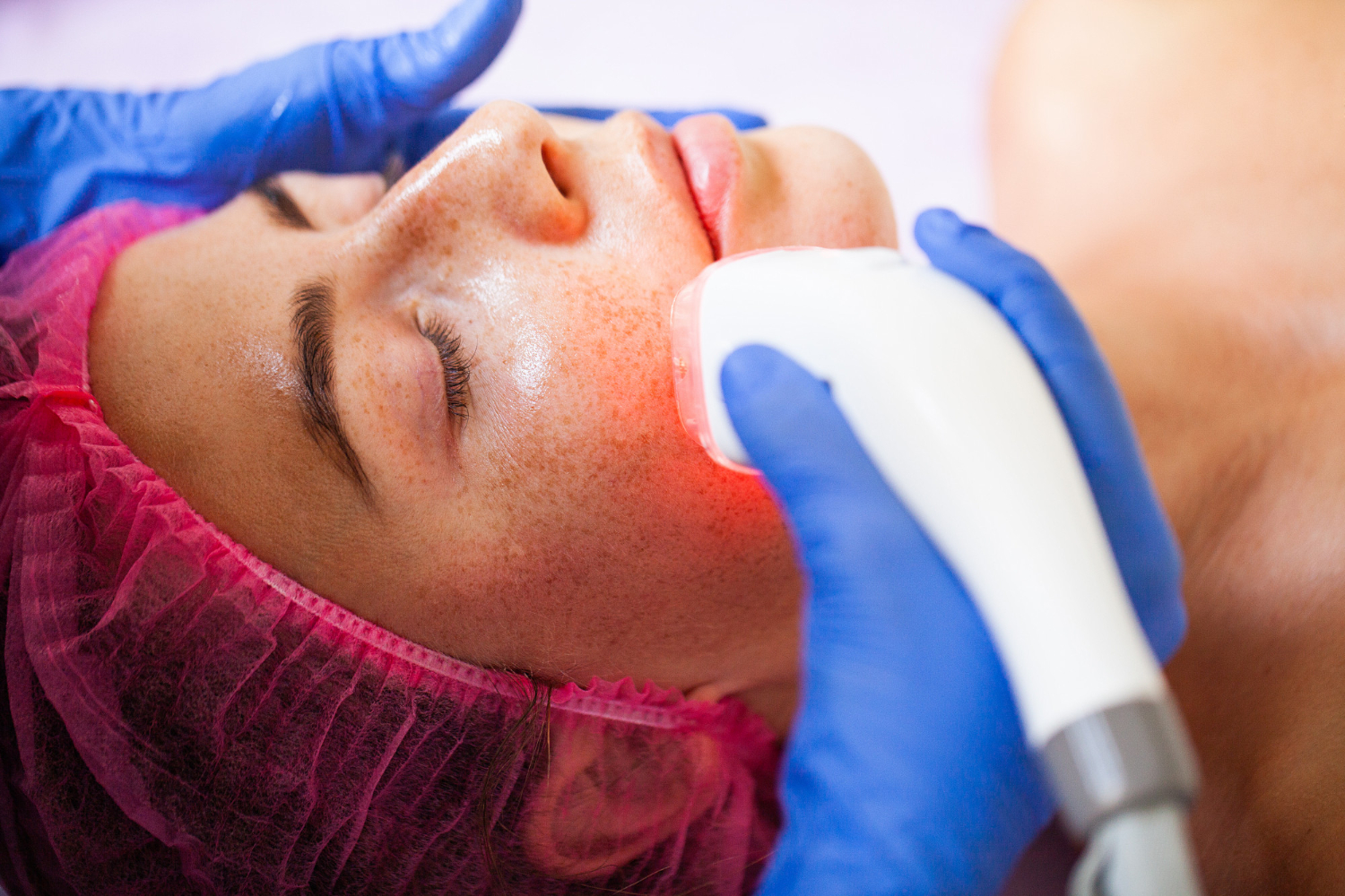 dermatologist performing ultherapy treatment at reveal clinics riyadh