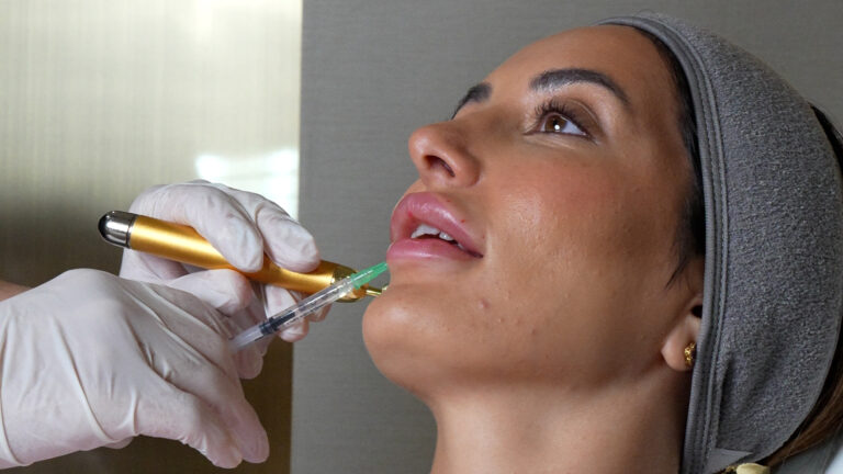 Lip Filler