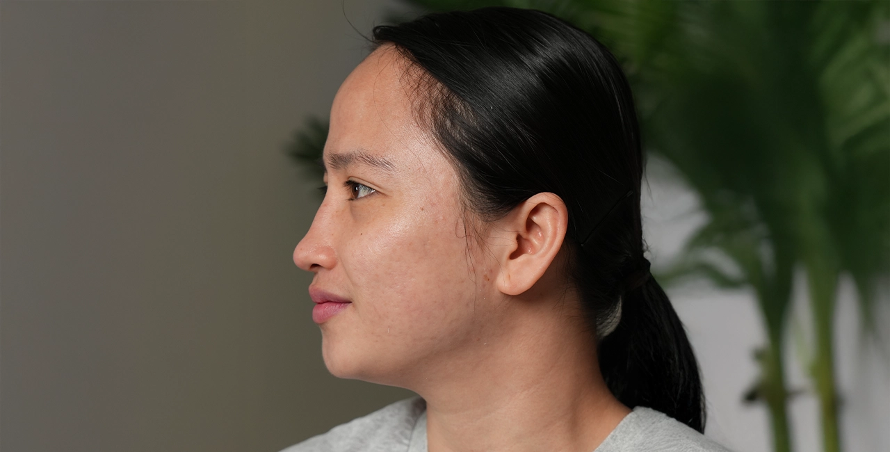Home 21 After treatment result