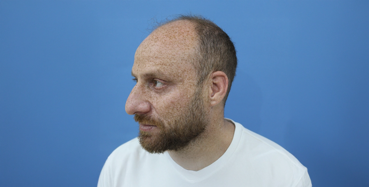 Home 14 Before treatment result