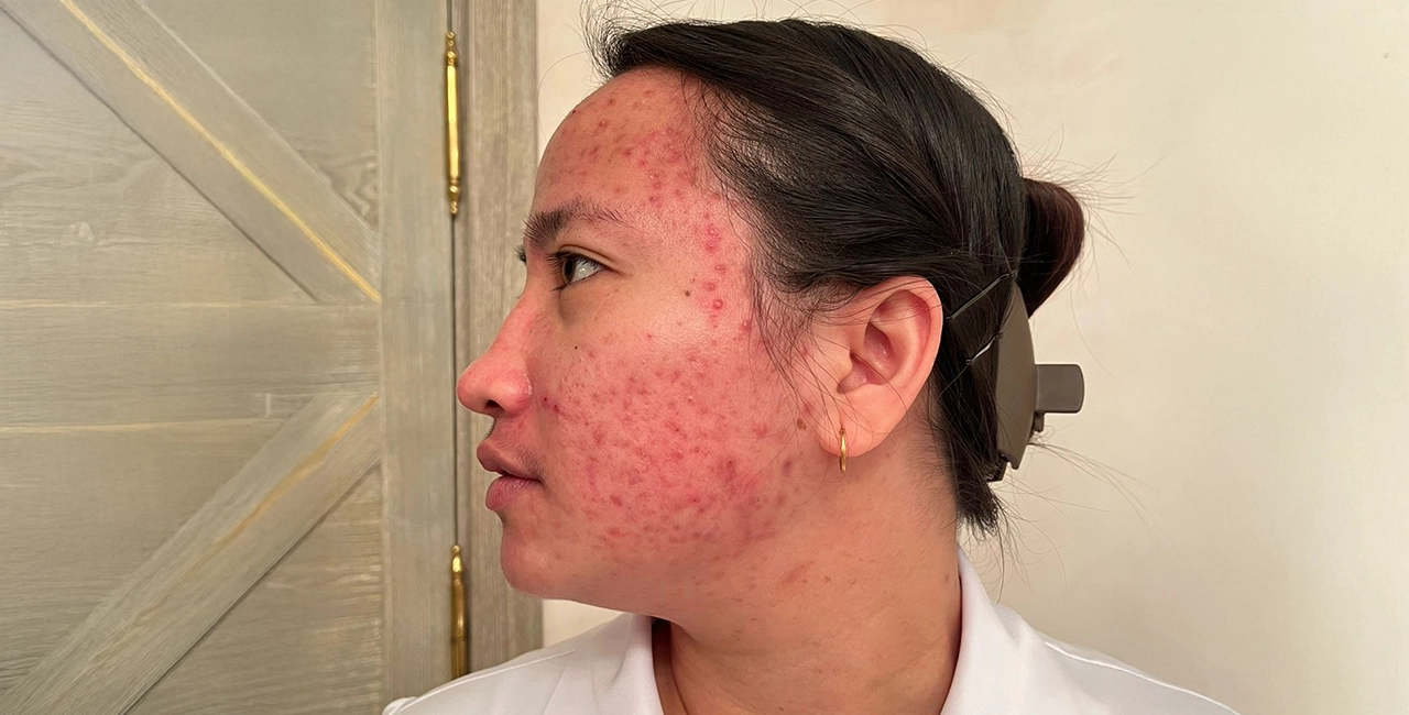Home 20 Before treatment result