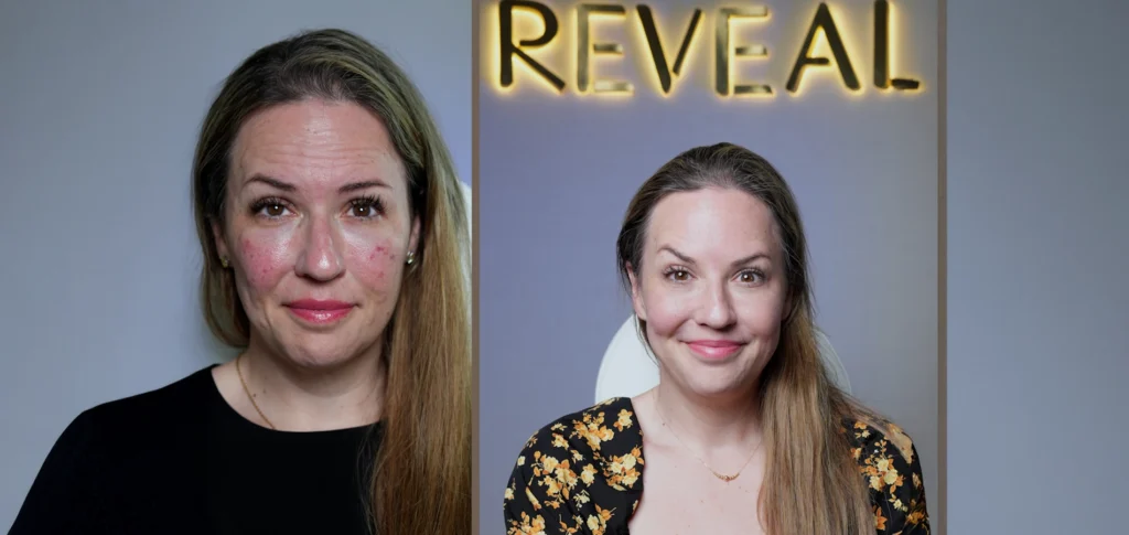 Botox consultation at Reveal Clinic in Riyadh for natural facial rejuvenation and anti-aging treatment without surgery