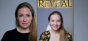 Botox consultation at Reveal Clinic in Riyadh for natural facial rejuvenation and anti-aging treatment without surgery
