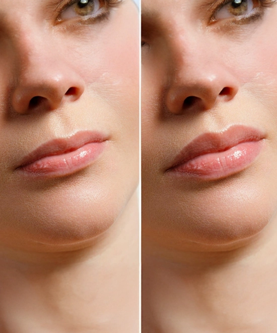 Dermatologist for Radiesse Fillers in Riyadh