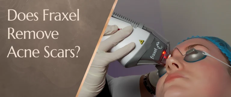 Does Fraxel Remove Acne Scars