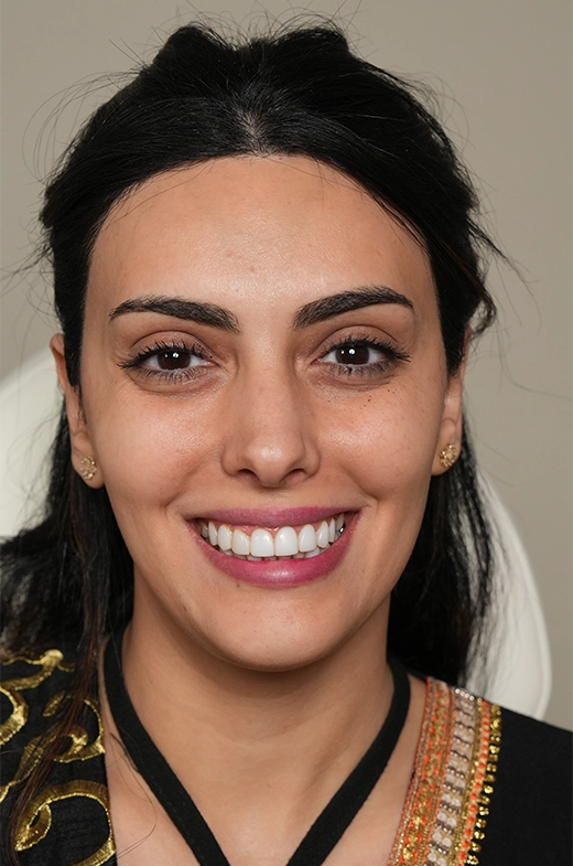 Crow's Feet Botox Treatment 1 side image banner copy 1