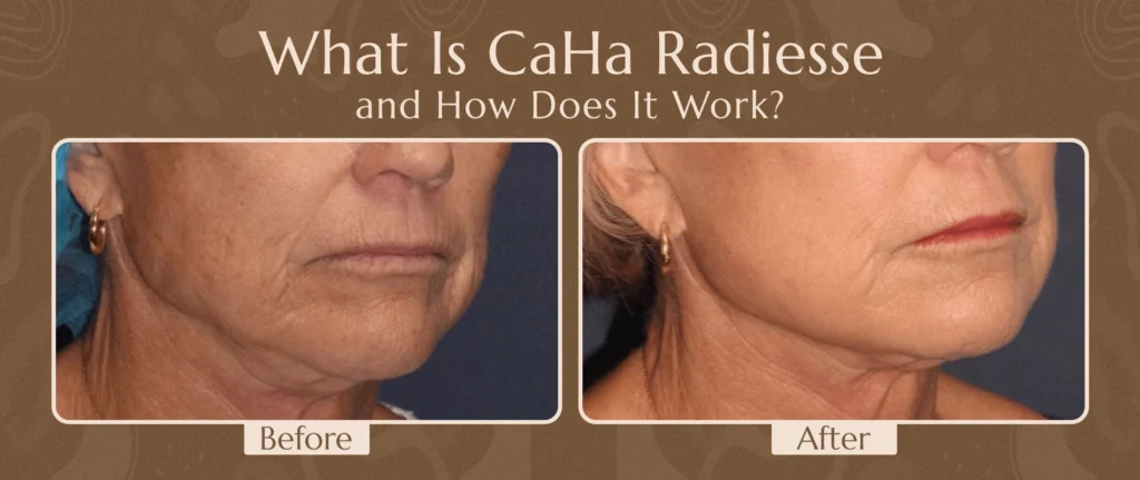 What Is CaHa Radiesse and How Does It Work? 1 What Is CaHa Radiesse and How Does It Work?