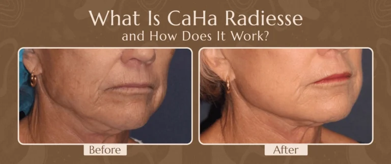What Is CaHa Radiesse and How Does It Work?