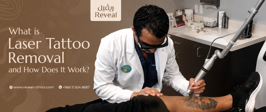 what is laser tattoo removal and how does it work